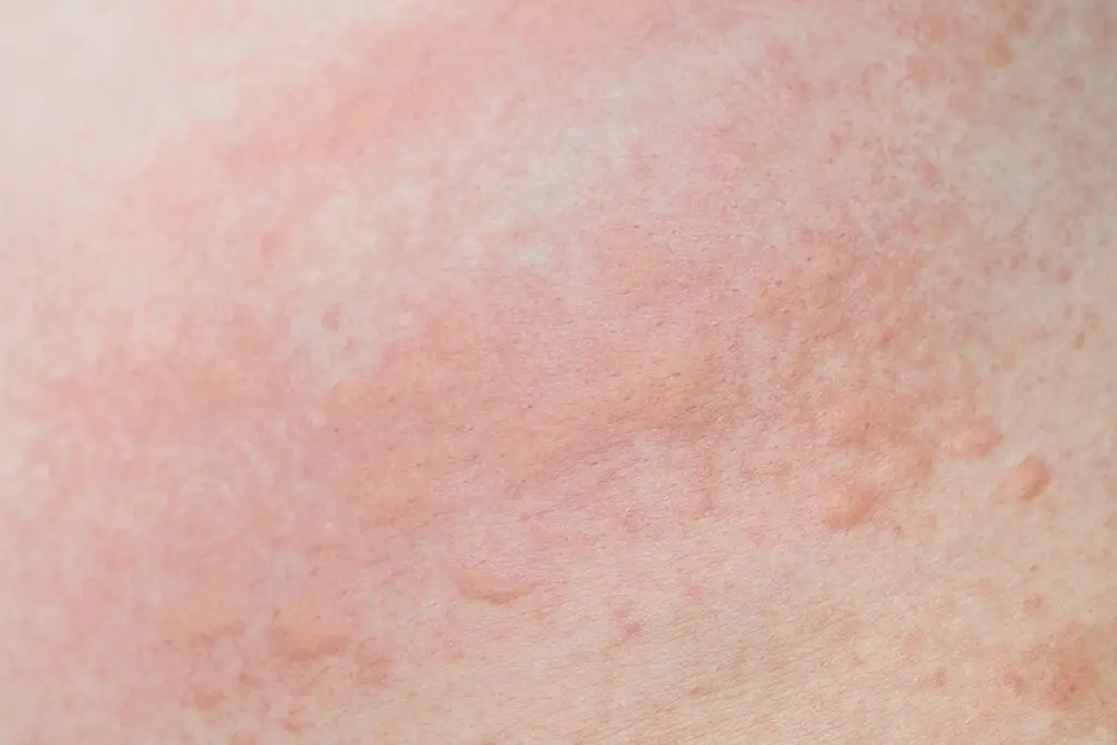 What Is Hot Tub Rash Causes And Prevention One Hot Tub